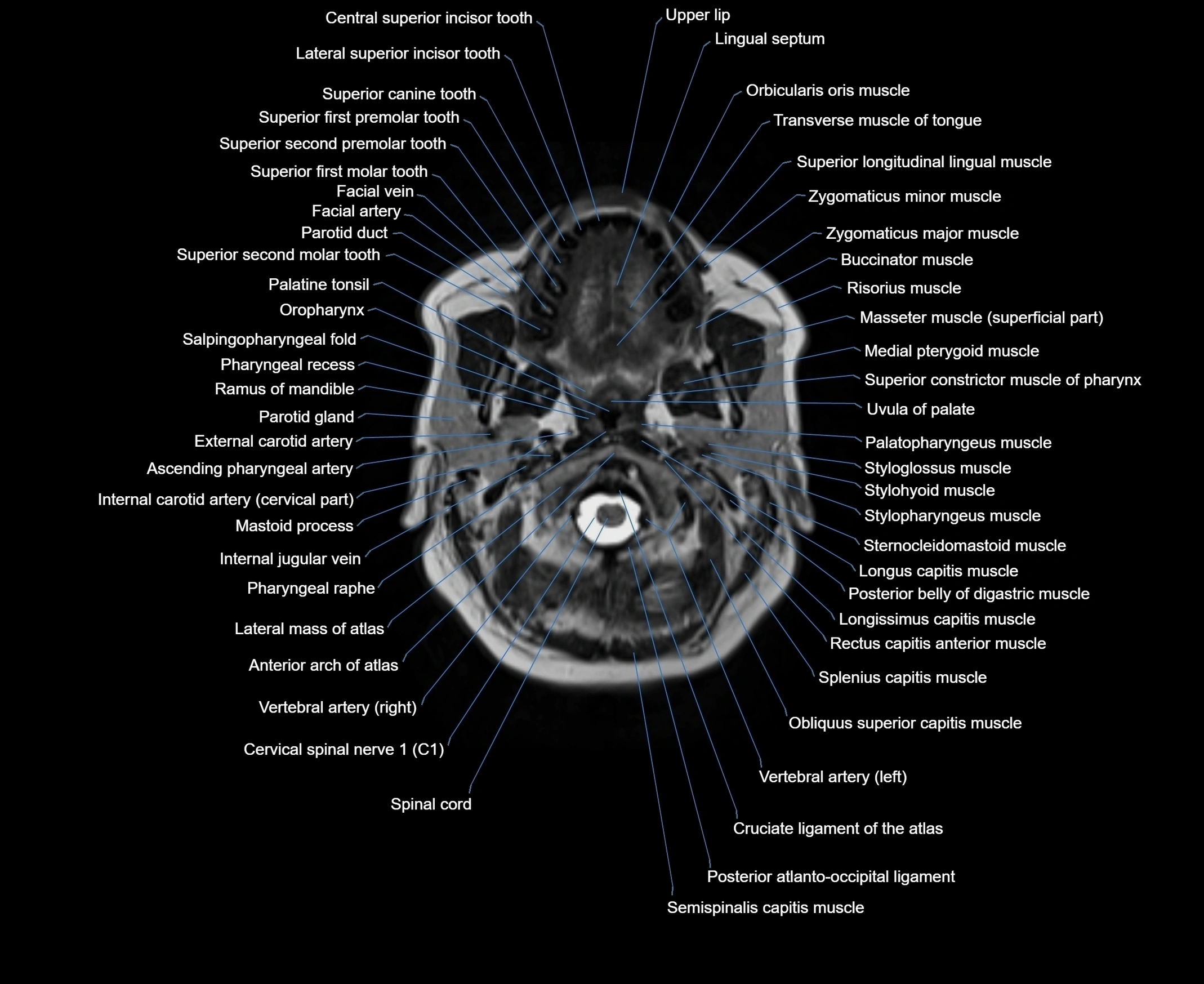 MRI Neck 3D labelled cross section anatomy axial 3t image-00001-00024.webp